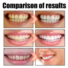 Oral hygiene kit (oil puller, tongue scraper)